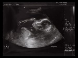 Endometrioza a stan błogosławiony – jak endometrioza wpływa na ciążę